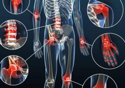 АРТРИТ СИМПТОМИ. ВИДОВЕ АРТРИТ. ЛЕКАРСТВА ЗА АРТРИТ