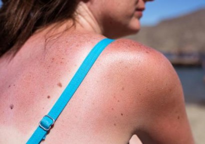 БЕНКИТЕ, СЛЪНЦЕТО, КРЕМОВЕТЕ ЗА ИЗГАРЯНЕ И РАКА НА КОЖАТА