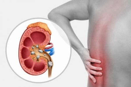 КАМЪНИ В БЪБРЕЦИТЕ. УРОЛИТИАЗА. ВИДОВЕ, СИМПТОМИ И ЛЕЧЕНИЕ КАМЪНИ В БЪБРЕЦИТЕ. УРОЛИТИАЗА. ВИДОВЕ, СИМПТОМИ И ЛЕЧЕНИЕ