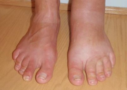 ПОДУВАНЕ НА КРАКАТА. ЯБЪЛКОВ ОЦЕТ ЗА ПОДУТИ КРАКА