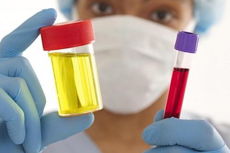 АЛБУМИН В УРИНАТА. КАК СЕ ЛЕКУВА БЕЛТЪК В УРИНАТА