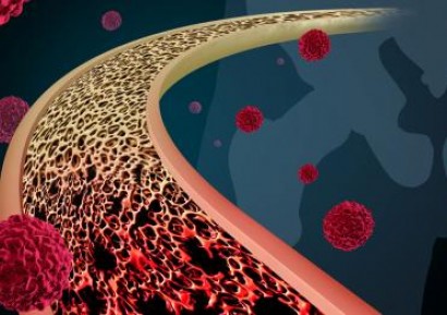 РАК НА КОСТИТЕ. ВИДОВЕ, СИМПТОМИ, ПРИЧИНИ И ЛЕЧЕНИЕ