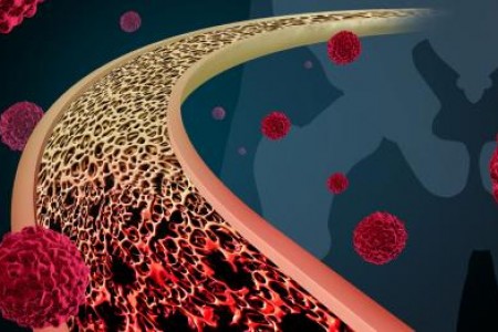 РАК НА КОСТИТЕ. ВИДОВЕ, СИМПТОМИ, ПРИЧИНИ И ЛЕЧЕНИЕ