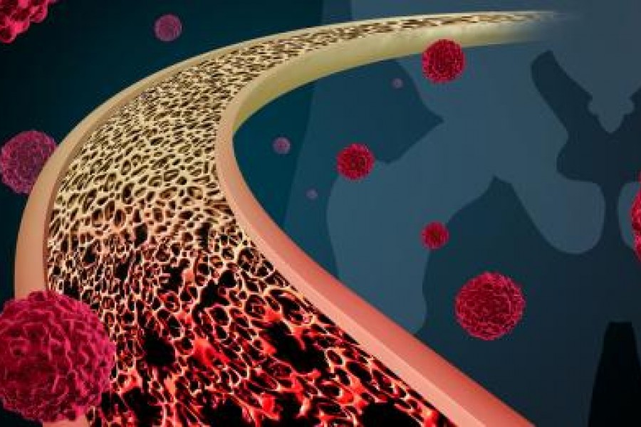 Рак на костите. Видове, симптоми, причини и лечение