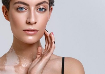 ВИТИЛИГО ЛЕЧЕНИЕ. ВИТИЛИГО ПРИЧИНИ. ВИТИЛИГО СИМПТОМИ