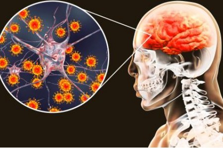 СИМПТОМИ НА МЕНИНГИТ. ЛЕЧЕНИЕ НА МЕНИНГИТ. ВИДОВЕ МЕНИНГИТ