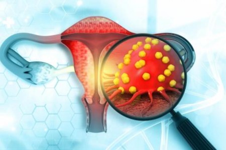 РАК НА ЯЙЧНИЦИТЕ СИМПТОМИ | ТУМОРНИ МАРКЕРИ | ЛЕЧЕНИЕ