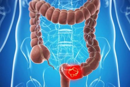 РАК НА ДЕБЕЛОТО ЧЕРВО СИМПТОМИ |КРЪВНИ ИЗСЛЕДВАНИЯ |ЛЕЧЕНИЕ