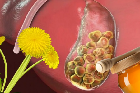 СТОПЯВАНЕ НА КАМЪНИ В ЖЛЪЧКАТА | БИЛКОВИ РЕЦЕПТИ | ДИЕТА