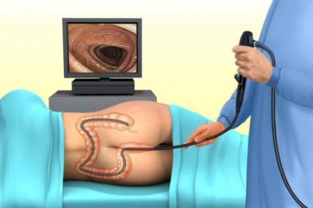 КОЛОНОСКОПИЯ |ЦЕНИ НА КОЛОНОСКОПИЯ |ВИРТУАЛНА КОЛОНОСКОПИЯ
