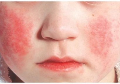 ПЕТА БОЛЕСТ | БУМ ПРИ ДЕЦАТА | ПРИЧИНИ И СИМПТОМИ | ЛЕЧЕНИЕ