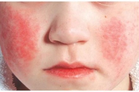 ПЕТА БОЛЕСТ | БУМ ПРИ ДЕЦАТА | ПРИЧИНИ И СИМПТОМИ | ЛЕЧЕНИЕ