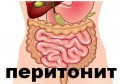 ПЕРИТОНИТ СИМПТОМИ | СМЪРТНОСТ ПРИ ПЕРИТОНИТ | ДИЕТА