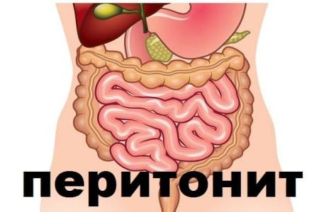 ПЕРИТОНИТ СИМПТОМИ | СМЪРТНОСТ ПРИ ПЕРИТОНИТ | ДИЕТА