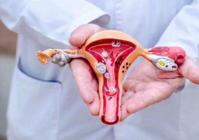 КАК ДА СЕ ОТЪРВЕМ ОТ ПОЛИПИ В МАТКАТА | ЛЕЧЕНИЕ | БИЛКИ