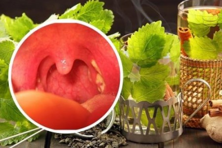 ГНОЙНА АНГИНА ДОМАШНО ЛЕЧЕНИЕ | РЕЦЕПТИ ЗА ВЪЗПАЛЕНО ГЪРЛО