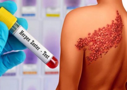 МАЗИЛО ЗА ХЕРПЕС ЗОСТЕР - ХЕПЕС ЗОСТЕР ЛЕЧЕНИЕ