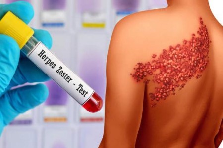 МАЗИЛО ЗА ХЕРПЕС ЗОСТЕР - ХЕПЕС ЗОСТЕР ЛЕЧЕНИЕ