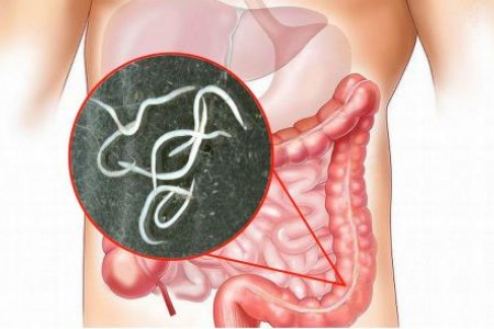 ПАРАЗИТИ В ЧЕРВАТА | КАК СЕ ЛЕКУВАТ | ДИЕТА И БИЛКИ