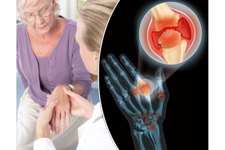 НАЙ-ЕФИКАСНОТО ЛЕКАРСТВО ЗА ПОДАГРА | БИЛКИ И РЕЦЕПТИ