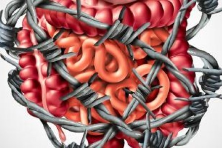 СИНДРОМ НА РАЗДРАЗНЕНОТО ЧЕРВО | СИМПТОМИ, ЛЕЧЕНИЕ, ДИЕТА