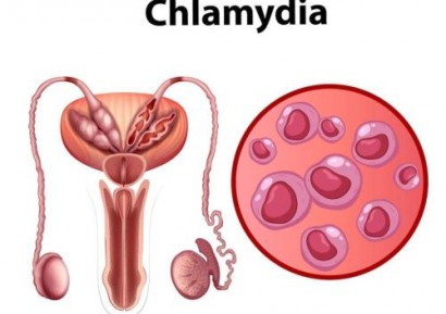 ХЛАМИДИЯ СИМПТОМИ | ИЗСЛЕДВАНИЯ, ЛЕЧЕНИЕ И УСЛОЖНЕНИЯ