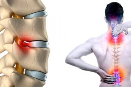 ОБЛЕГЧАВАНЕ НА БОЛКИ ПРИ ДИСКОВА ХЕРНИЯ | ЛЕКАРСТВА И БИЛКИ