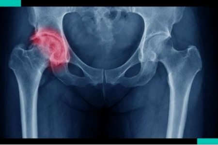 НАЙ-ДОБРОТО ЛЕКАРСТВО ЗА КОКСАРТРОЗА