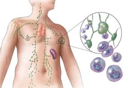 РАК НА ЛИМФНИТЕ ВЪЗЛИ |ЛИМФОМ НА ХОДЖКИН, НЕХОДЖКИНОВ ЛИМФОМ