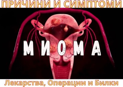 МИОМА НА МАТКАТА | СИМПТОМИ - ЛЕКАРСТВА, ОПЕРАЦИИ И БИЛКИ