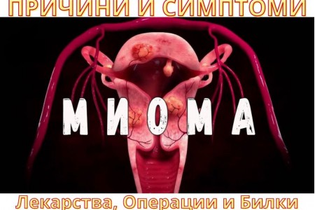 МИОМА НА МАТКАТА | СИМПТОМИ - ЛЕКАРСТВА, ОПЕРАЦИИ И БИЛКИ