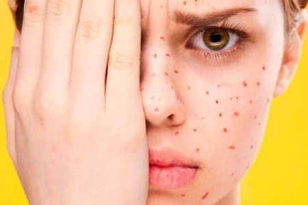 ВАРИЦЕЛА ПРИ ВЪЗРАСТНИ | КАК СЕ ЛЕКУВА | СИМПТОМИ И ДИЕТА