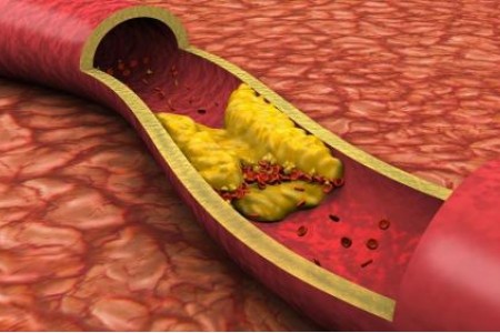 АТЕРОСКЛЕРОЗА - ОСЕМ ПРОДУКТА, КОИТО ПОМАГАТ