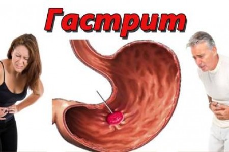 ГАСТРИТ СИМПТОМИ | КЪДЕ БОЛИ ГАСТРИТ | ХАПЧЕТА ЗА ГАСТРИТ ГАСТРИТ СИМПТОМИ | КЪДЕ БОЛИ ГАСТРИТ | ХАПЧЕТА ЗА ГАСТРИТ