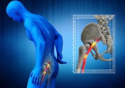 ИШИАС НА СЕДАЛИЩНИЯ НЕРВ - ПРИЧИНИ, СИМПТОМИ, ЛЕЧЕНИЕ