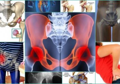 КОКСАРТРОЗА НА ТАЗОБЕДРЕНА СТАВА -ПРИЧИНИ, СТАДИИ И ЛЕЧЕНИЕ