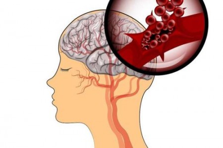 МОЗЪЧЕН КРЪВОИЗЛИВ - ПРИЧИНИ, СИМПТОМИ И КАК СЕ ЛЕКУВА