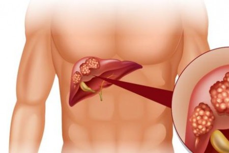 КОЛКО СЕ ЖИВЕЕ С РАК НА ЧЕРНИЯ ДРОБ | ЕТАПИ И ЛЕЧЕНИЕ