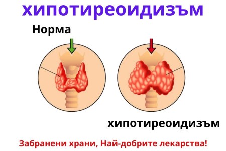 ХИПОТИРЕОИДИЗЪМ СИМПТОМИ | ЗАБРАНЕНИ ХРАНИ | КАК СЕ ЛЕКУВА