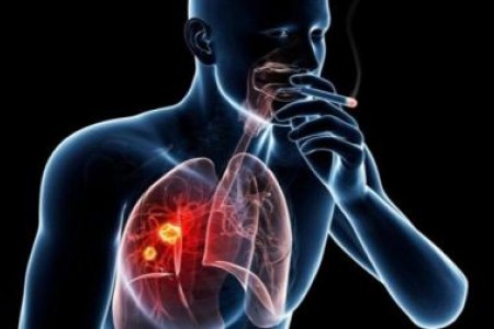 РАК НА БЕЛИЯ ДРОБ СИМПТОМИ. СТАДИИ, ЛЕКАРСТВА, ХИМИОТЕРАПИЯ