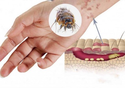 КРАСТА |КОГА ИЗЧЕЗВАТ ПЪПКИТЕ ОТ КРАСТА |ЛЕКАРСТВА И БИЛКИ