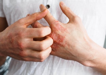 ЕКЗЕМА ПО РЪЦЕТЕ | ЕКЗЕМИ ПО КРАКАТА | ЕКЗЕМА ЛЕЧЕНИЕ