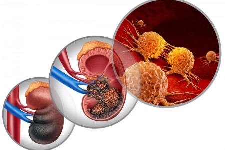 КОЛКО СЕ ЖИВЕЕ С РАК НА БЪБРЕКА | СИМПТОМИ И ЛЕЧЕНИЕ