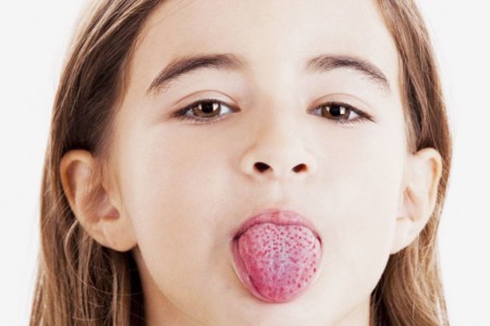 СКАРЛАТИНА СИМПТОМИ | СКАРЛАТИНА ЛЕЧЕНИЕ И ДИЕТА