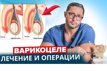 ВАРИКОЦЕЛЕ - ПРИЧИНИ И СИМПТОМИ | ОПЕРАТИВНО ЛЕЧЕНИЕ