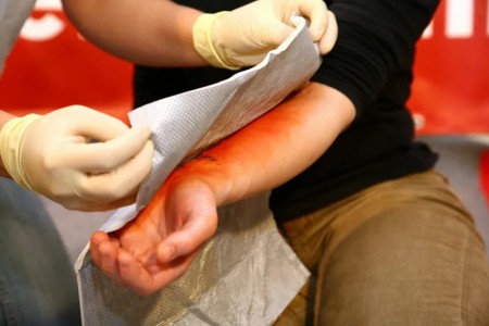 НАРОДНА МЕДИЦИНА ПРИ ИЗГАРЯНЕ | ДОМАШЕН МЕХЛЕМ ЗА ИЗГАРЯНЕ