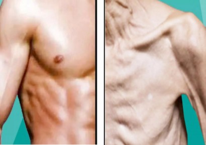 МУСКУЛНА ДИСТРОФИЯ ЛЕЧЕНИЕ | СИМПТОМИ И ВИДОВЕ