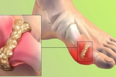 ВИСОКА ПИКОЧНА КИСЕЛИНА | ПИКОЧНА КИСЕЛИНА ДИЕТА
