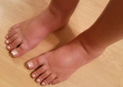 БЪРЗ ЛЕК ЗА ОТОК НА КРАКАТА | БИЛКИ, ДОБАВКИ И ЛЕКАРСТВА