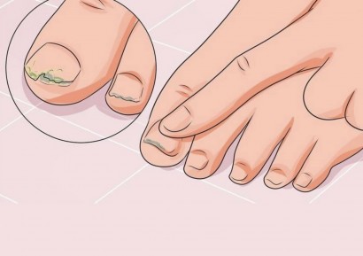 ГЪБИЧКИ ПО КРАКАТА - СИПМТОМИ, ПРИЧИНИ, ЛЕЧЕНИЕ